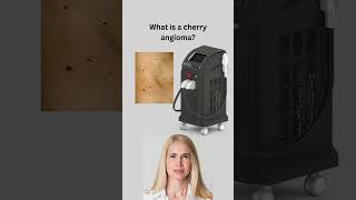 What is a cherry angioma [upl. by Otrebcire]