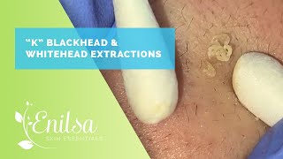 Blackhead amp Whitehead Extractions on quotKquot Part 3 [upl. by Ardel658]