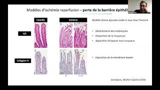Ischémie mésentérique  Simon BOURCIER [upl. by Airotciv32]