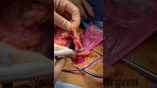 Inside the OR with justageneralsurgeon  hernia contents amp ligasure of omental fat before repair [upl. by Uda963]