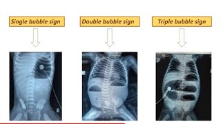 Abdominal XRays Intestinal Obstruction  Pediatrics [upl. by Nasas198]