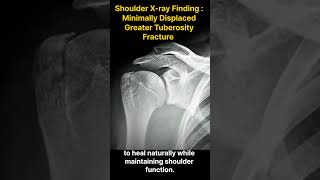 Greater Tuberosity Fracture From Diagnosis to Recovery 대결절 골절 진단에서 회복까지 [upl. by Neryt59]