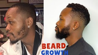 HOW I GREW MY BEARD USING MINOXIDIL  GET RID OF PATCHY BEARD [upl. by Sinoda430]