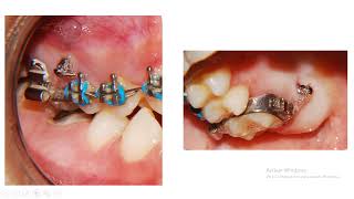 ¿Cómo es la intrusión molar en Ortodoncia y mini tornillos CUANDO UNA MUELITA SE SALE DEL HUESO 👍 [upl. by Hazeghi62]