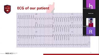 Arrhythmia case discussion [upl. by Cull]