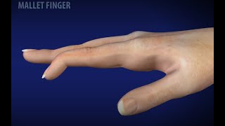 Mallet Finger [upl. by Ozen75]