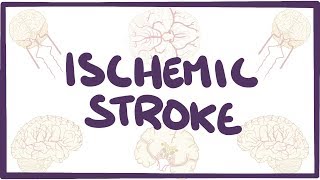 Ischemic Stroke  causes symptoms diagnosis treatment pathology [upl. by Attelrak922]