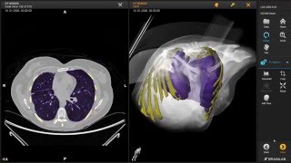 3D Slicer  Brainlab interoperability demonstration at RSNA 2015 [upl. by Tamah395]