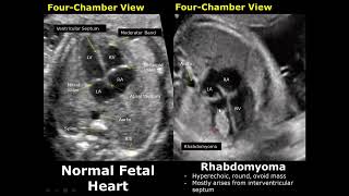 Fetal Chest Ultrasound Normal Vs Abnormal Image Appearances  Echocardiography  Heart amp Lungs USG [upl. by Sperry]