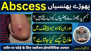 Abscess پھوڑے پھنسیاں फोड़ा Homeopathic Treatment By Dr Waqar Bhutta In Urdu Hindi [upl. by Norraj]