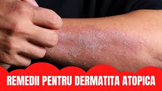 DERMATITA ATOPICA [upl. by Steffin775]