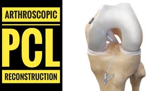 Arthroscopic PCL Posterior Cruciate LigamentReconstruction with Hamstring Graft [upl. by Conny194]