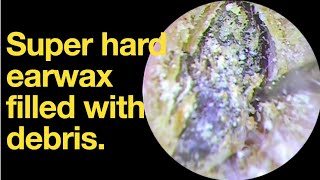 Super hard earwax filled with debris ear wax removal  ear cleaning  ASMR  relaxation  relax [upl. by Flem]