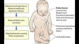 Oligohydramnios and polyhydroaminos 2 [upl. by Coop]