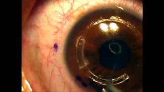 Intacs for keratoconus using the intralase femtosecond laser [upl. by Reidid]