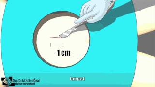 lumbar microdiscectomy disc herniation operation animation video [upl. by Ihdin]