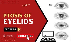 Understanding Ptosis A Comprehensive Ophthalmology Lecture [upl. by Madelle]