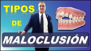 MALOCLUSION DENTAL  FACTORES QUE CAUSAN [upl. by Ennaj]