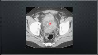 Clase 19 Radiologia de la enfermedad diverticular del colon Diverticulitis Clasificación Hinckey [upl. by Kolva]