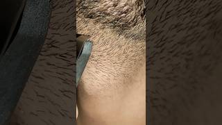 ingrown hair removalremovery hairstyle hair [upl. by Deehan611]