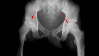 Avascular necrosis of the femoral heads [upl. by Nanis]