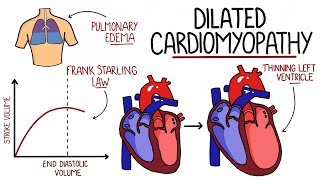 Dilated Cardiomyopathy Made Easy DCM [upl. by Aratal]