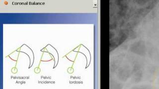 TraumaCad  Pelvic Radius Angle [upl. by Mclaughlin]