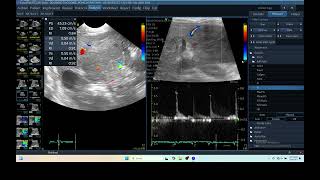 IQ 279 LIVER ULTRASOUND HEPATOMA ECHOPAC ANALYSIS ECHOCARDIOGRAPHY CFM PW MODE 2 [upl. by Aiynat]