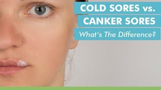 Cold Sores vs Canker Sores Whats The Difference [upl. by Hnil]