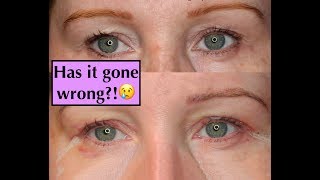 Blepharoplasty Experience UK Eyelid SurgeryHooded Eyes  1 WkStitches Removed [upl. by Gambell185]