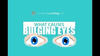 BULGING EYES  Causes Symptoms and Treatment  Exophthalmos Exopthalmia Exorbitsm and Proptosis [upl. by Yesnikcm]