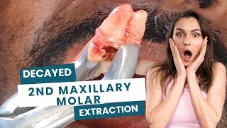 Upper molar decayed extraction  upper 2nd molar extraction  molar tooth extraction [upl. by Rodoeht]