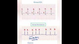 Atrial fibrillation ECG  USMLE Step 1 amp 2 [upl. by Eentrok]