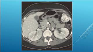 Case Discussion 005 striated nephrogram [upl. by Annora]