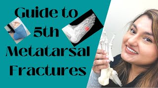 Guide to 5th Metatarsal Fractures [upl. by Assirol]