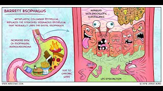 Barretts esophagus Causes clinical picture treatment HIGH YIELD [upl. by Abekam247]