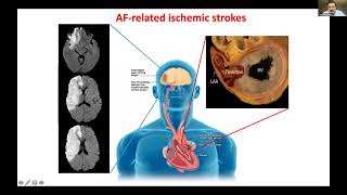 WSA Webinar  Cerebral Amyloid Angiopathy ICH and Afib Stroke Prevention Approaches [upl. by Boesch]