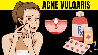 Acne Vulgaris  Causes Risk Factors Signs And Symptoms And Various Treatment Options [upl. by Nylzaj]