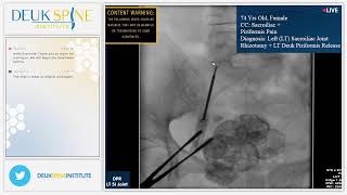 Sacroiliac Joint Rhizotomy for Sacroiliitis [upl. by Lancelle]