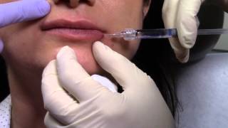 Lip Enhancement  Restylane Silk With Microcannula For Lip Voulme  Lip Augmentation  Dr Jason Emer [upl. by Hailey]