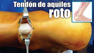 LESIONES del TENDÓN de AQUILES 🦶🏼 Causas Síntomas Tratamiento y Cirugía ⭐ Dr EDSON SERRANO Neomedica [upl. by Reiss324]