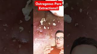 Outrageous BLACKHEAD REMOVAL  How Dare They Do This shorts [upl. by Kcyred]