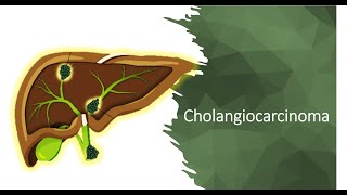 Cholangiocarcinoma [upl. by Rutherford798]