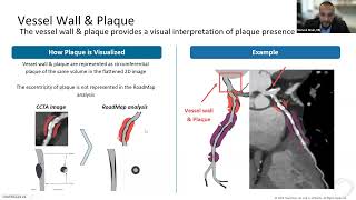 Expanding the CCTA Toolkit The impact of anatomic visualization with the HeartFlow RoadMap analysis [upl. by Okihcim]