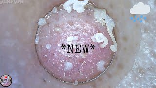 New Blackhead Removal Session  Rain brpvph [upl. by Acessej]