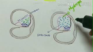 menieres disease  ENT  inner ear disease  etiology  clinical features  diagnosis  treatment [upl. by Gerty]