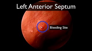 Left nasal cautery with silver nitrate [upl. by Dempster274]