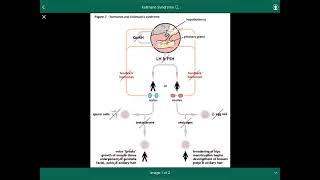 Kallmann Syndrome  متلازمة كولمان [upl. by Anaeda]