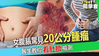 【精選】50歲媽腹痛腹脹驚見20公分腫瘤！7成卵巢癌末期才發現？！醫生教你1招看肚臍檢測！【 57healthy 】 [upl. by Aicissej]