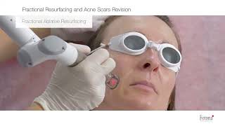 Fractional Ablative Resurfacing and Acne Revision [upl. by Gean]